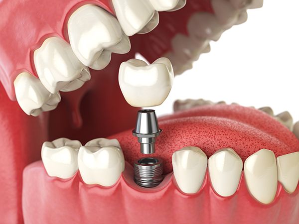 implantologia dentale biassono dentisti dentalheart implantologia
