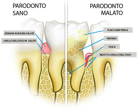 dentalheart biassono paradontite