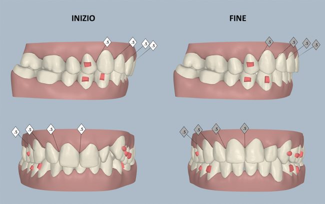 Risultato finale caso ortodontico dentalheart dentista biassono risultato ortodontico