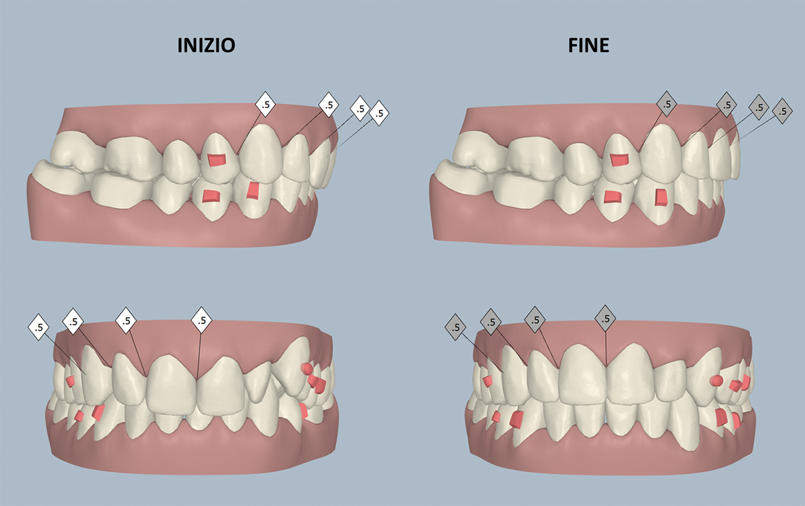 dentalheart dentista biassono risultato ortodontico