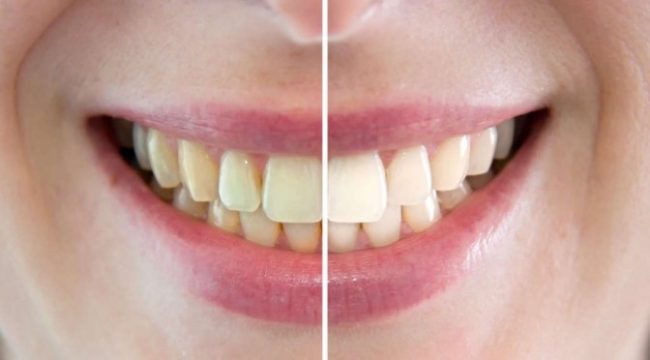 sbiancamento denti sbiancamento biassono
