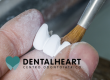 I costi degli impianti dentali: le migliori marche
