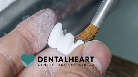 I costi degli impianti dentali: le migliori marche