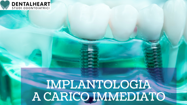 Implantologia a carico immediato