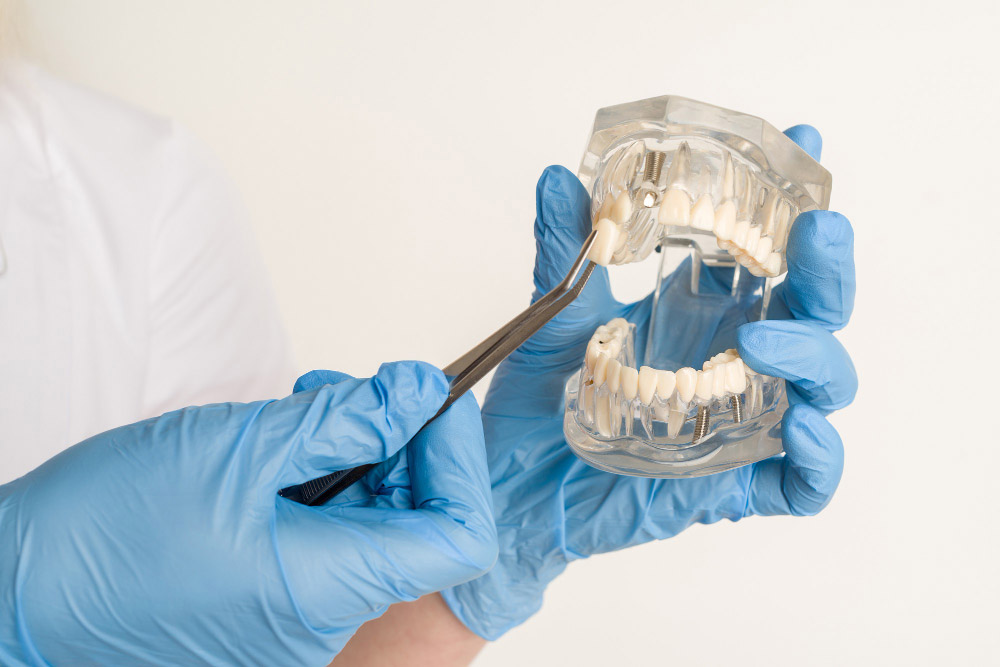 Impianti dentali senza osso Milano