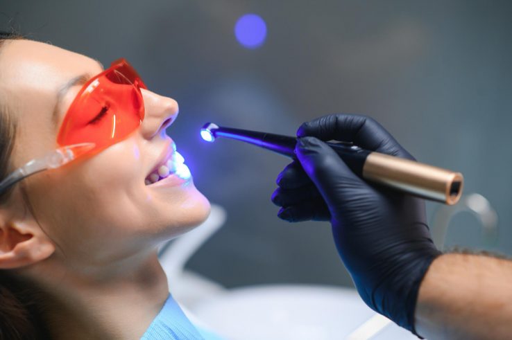 Laser gengive