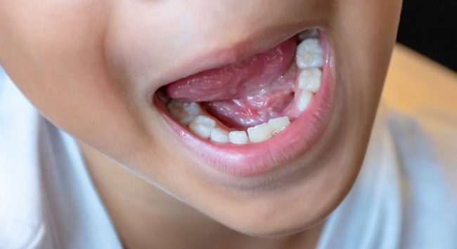 Diastema dentale Monza
