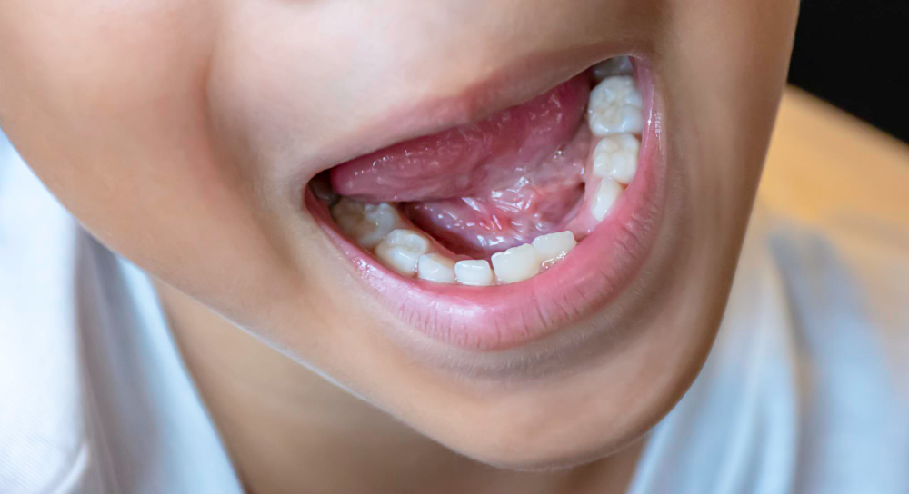 Diastema dentale Monza