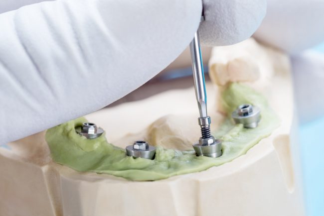Ricostruzione osso denti Ricostruzione osso denti