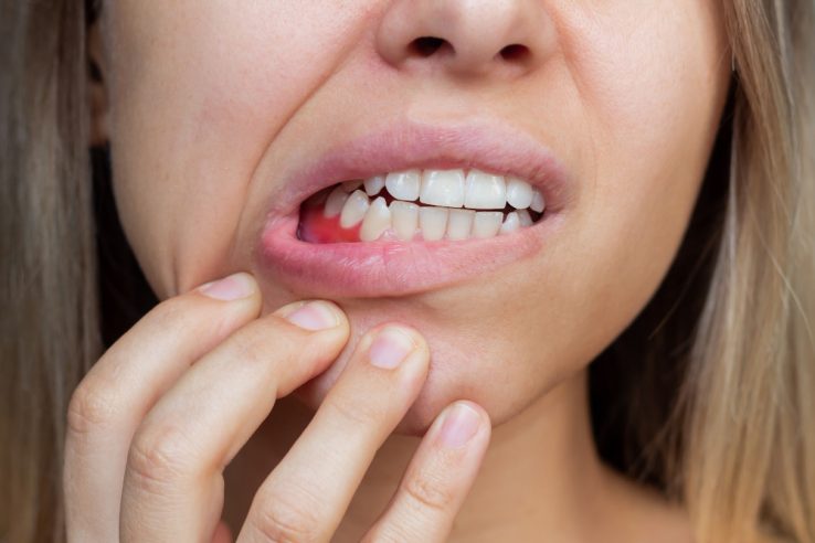 Ascesso dentale