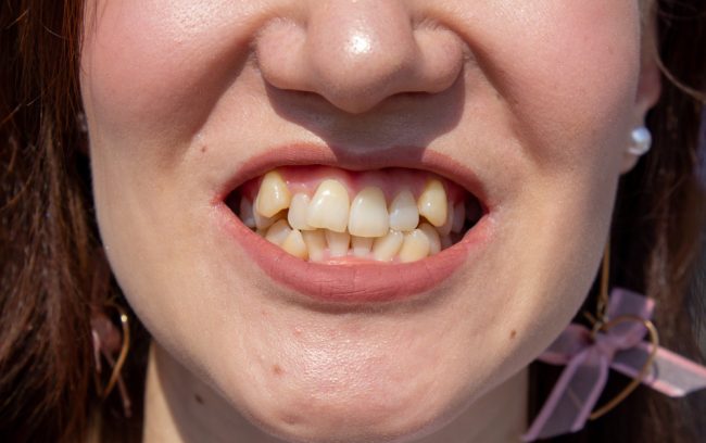 Malocclusione dentale Malocclusione dentale
