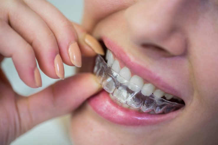 Bite dentale